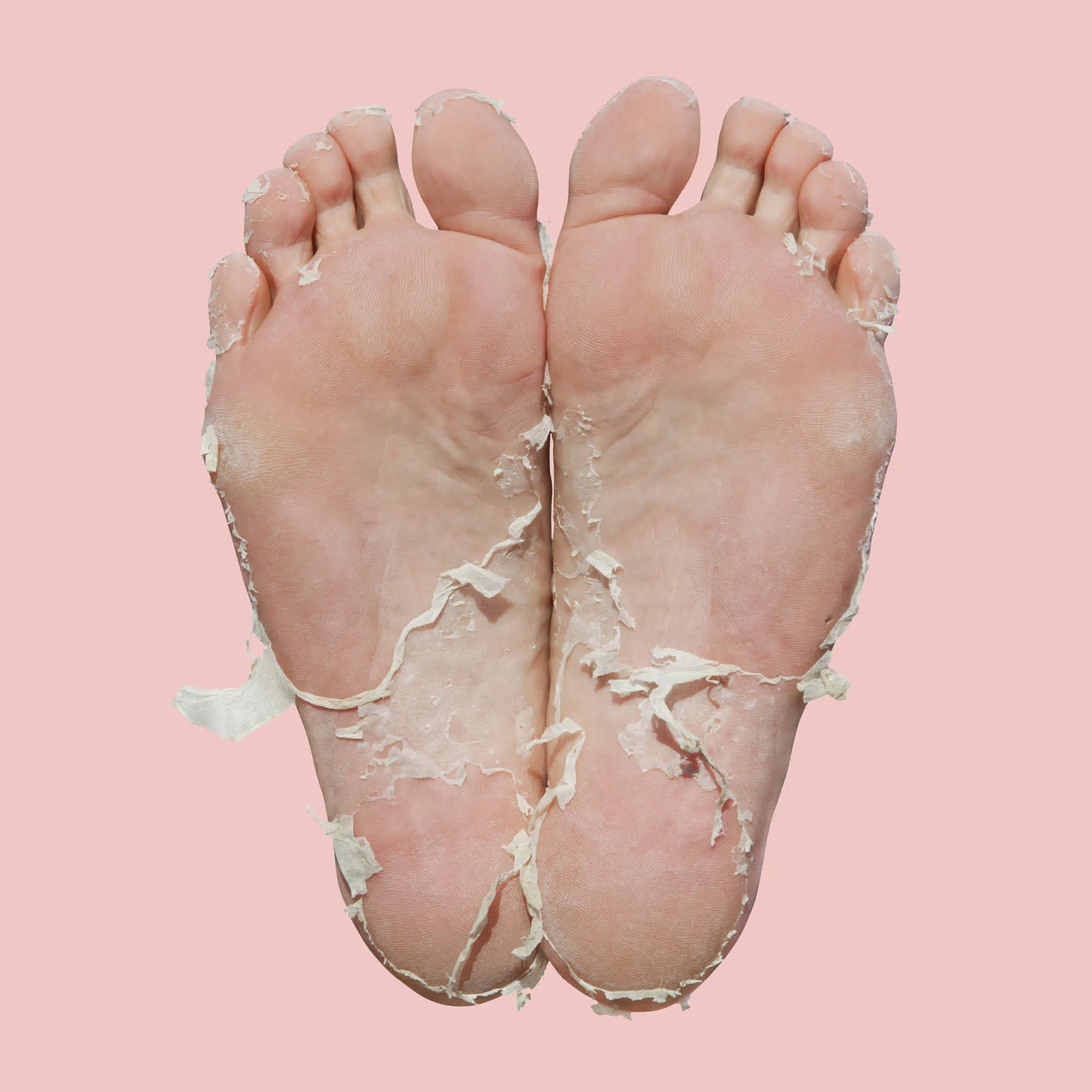 Foot Peel